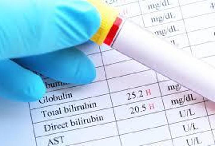 Bilirubin Ne Demek? Bilirubin Yüksekliği Ve Düşüklüğü Ne Anlama Gelir?