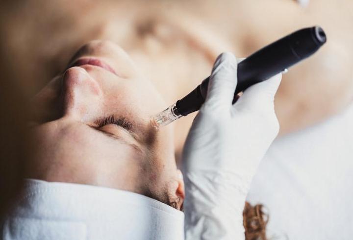 Dermapen Nedir, Ne İşe Yarar? Dermapen Tedavisi Nasıl Uygulanır?