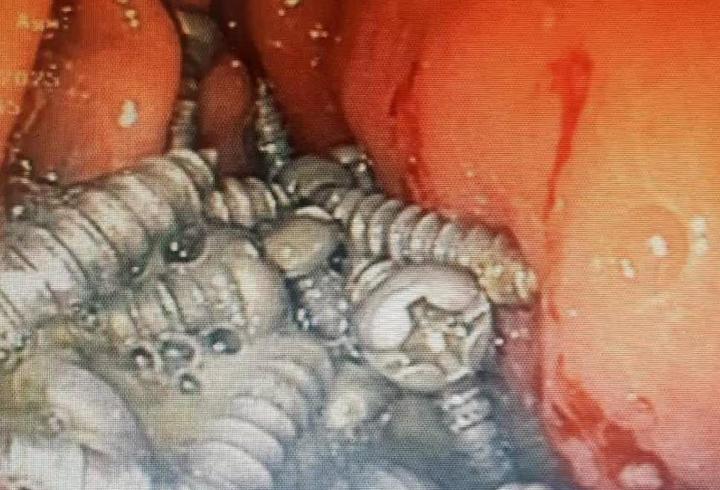Duyan inanamadı! 60 yaşındaki bir hastanın midesinden 47 tane cıvata çıktı