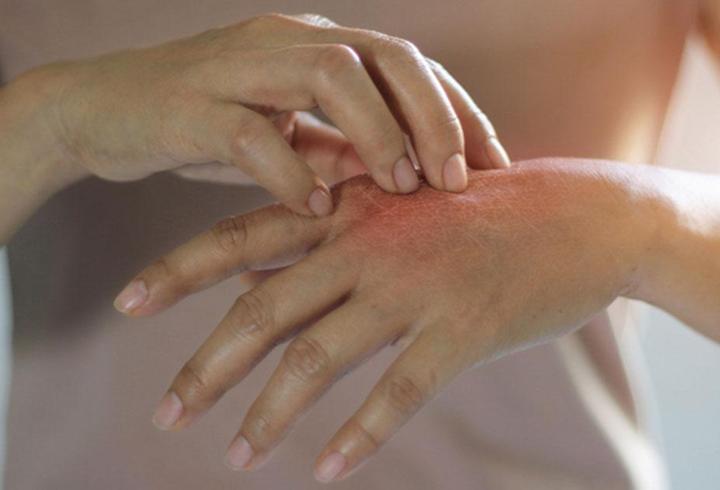 Egzama Nedir? Egzama Belirtileri, Nedenleri ve Etkili Tedavi Yöntemleri