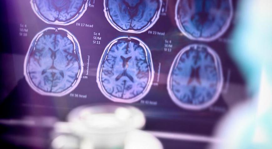 Alzheimer hastalığını erken evrede tespit edebilen kan testi!