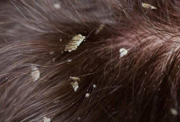 Seboreik Dermatit Nedir, Belirtileri Nelerdir? Seboreik Dermatit Tedavisi Nasıl Yapılır?