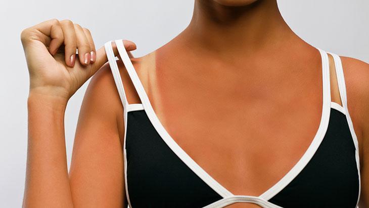Yazın çok moda ama aslında hasar belirtisi! ‘Sağlıklı bronzlaşma diye bir şey yok’