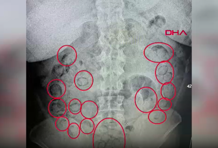 Aksaray’da akılalmaz olay! Midesinden 433 gram metamfetamin çıktı