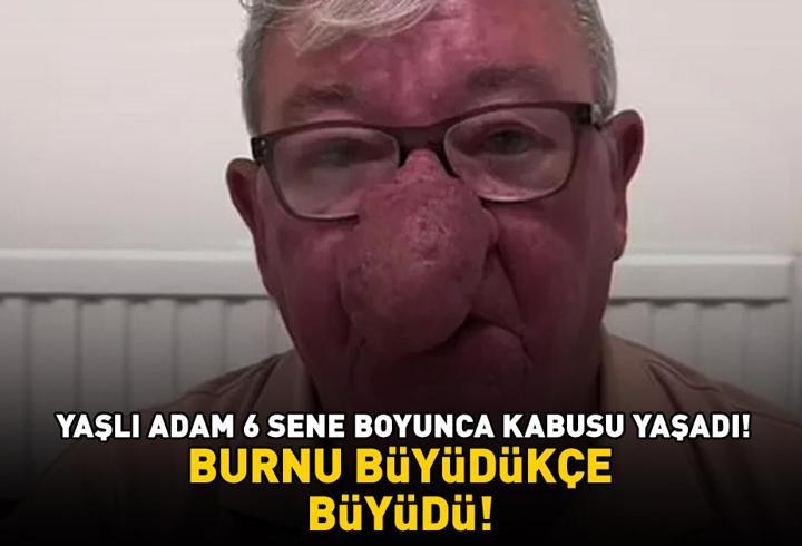Burnu büyüdükçe büyüdü! 68 yaşındaki adam kabusu yaşadı! 4 saatlik operasyonla adeta yeniden doğdu