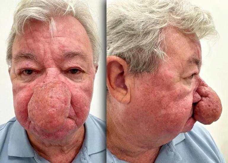 Burnu büyüdükçe büyüdü 68 yaşındaki adam kabusu yaşadı 4 saatlik operasyonla adeta yeniden doğdu