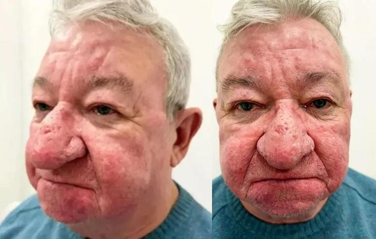 Burnu büyüdükçe büyüdü 68 yaşındaki adam kabusu yaşadı 4 saatlik operasyonla adeta yeniden doğdu