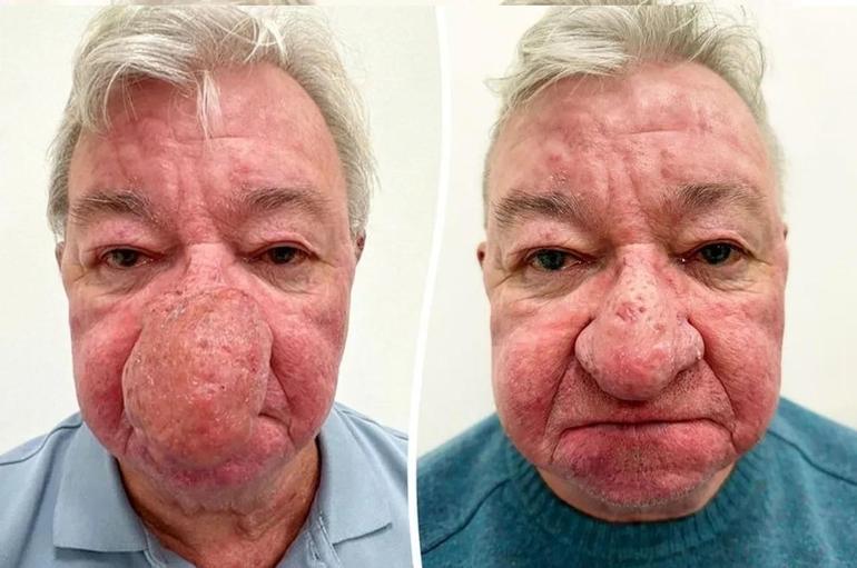 Burnu büyüdükçe büyüdü 68 yaşındaki adam kabusu yaşadı 4 saatlik operasyonla adeta yeniden doğdu