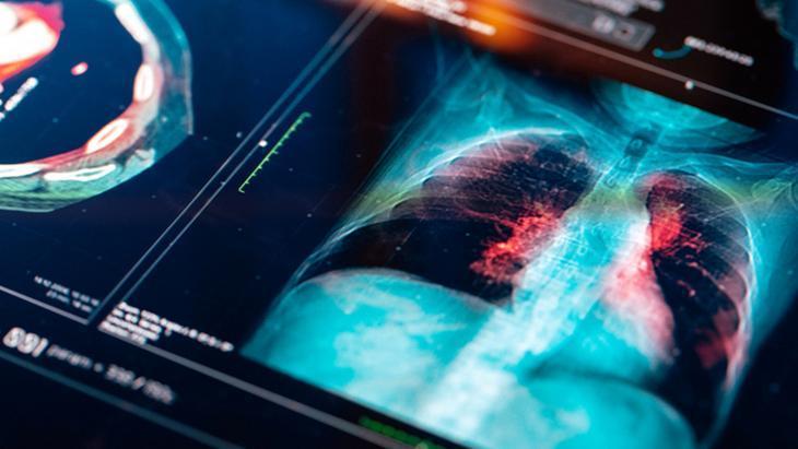 Akciğer kanseri neden sigara içmeyenlerde görülüyor?