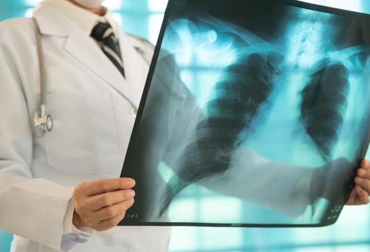 Erken tanı hayati önem taşıyor! Akciğer kanserinin belirtileri ne? “Öksürük, göğüs ağrısı, halsizlik, kanlı balgam…”