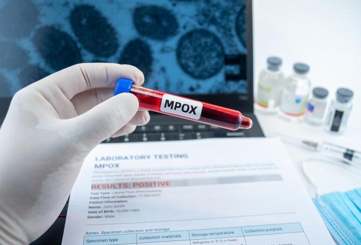 Maymun çiçeği virüsünde yeni varyant tespit edildi