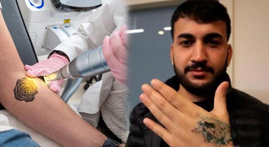 Dövme sildirecekti kabusu oldu: Deri ve doku nakli yapılacak! ‘Herkes ve her dövme uygun değil’