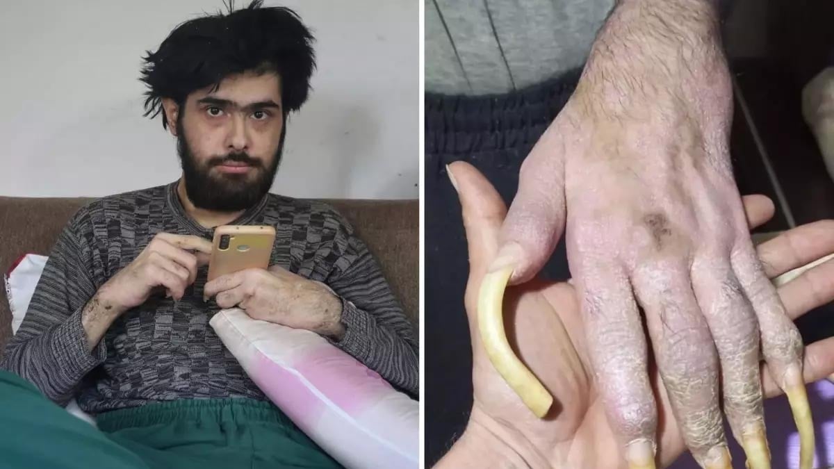 Türkiye’nin konuştuğu depremzede Barış’ın son halini görenler inanamıyor