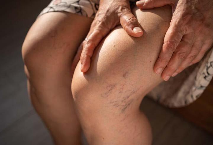 Varis tedavisi neden gerekir?