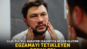 Egzamayı tetikliyor Cildi pul pul döküyor, kaşıntıya neden oluyor Bu besinlerden uzak durun