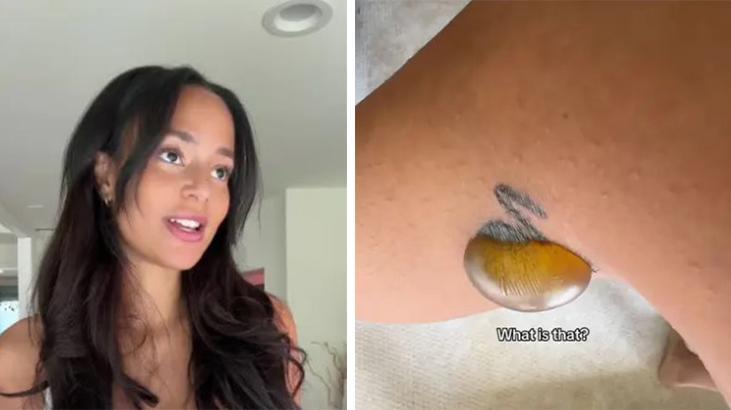 Dövme sildirmek isteyenler bir kez daha düşünsün! Ünlü fenomenin yaşadığı duyanlara hayret verdi