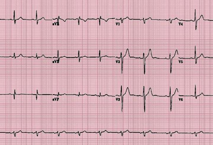Ekg Nedir, Neden Çekilir? Elektrokardiyografi Nasıl Yapılır?