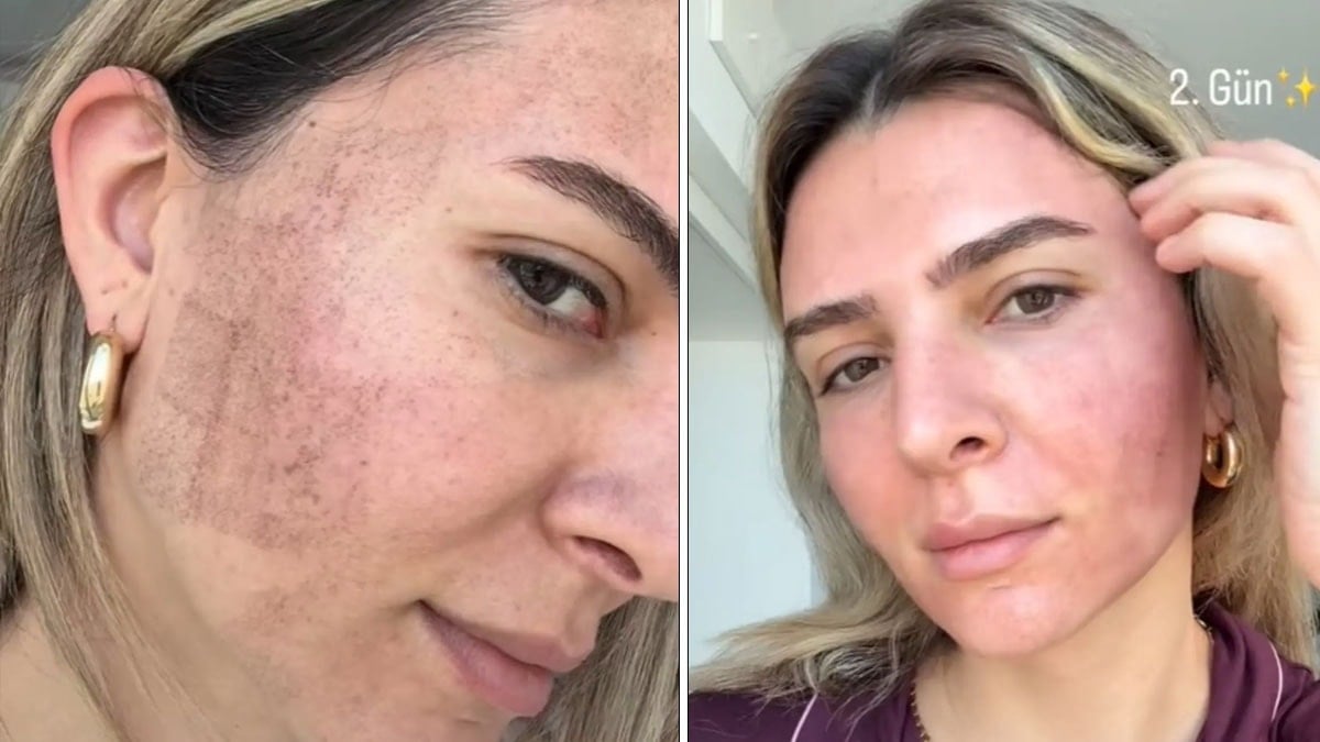 Cildine ışın gönderdi, ortaya çıkan değişim şaşırttı: Merve Aydın bile kendine inanamadı